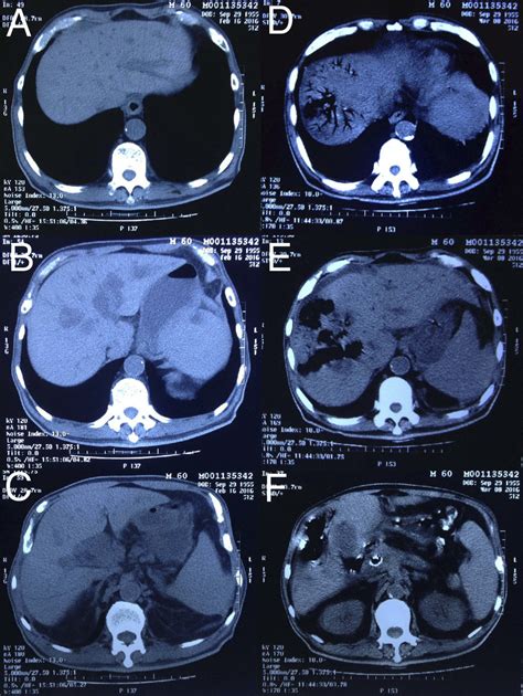 A C Abdominal Computed Tomography CT Before Stenting Revealed