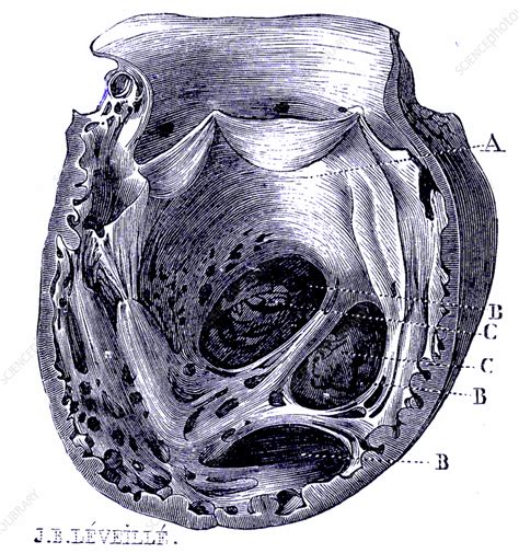 Aortic arch aneurysm, 19th century illustration - Stock Image - C059/6731 - Science Photo Library