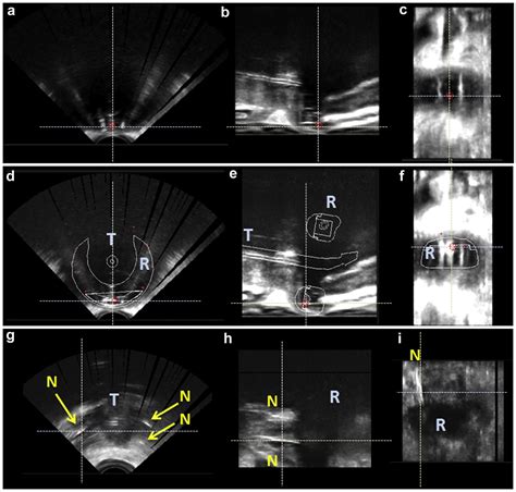 Combining Transrectal Ultrasound And Ct For Image Guided Adaptive Brachytherapy Of Cervical