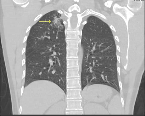 Uvular Necrosis After Oral Bronchoscopy With Bronchoalveolar Lavage A