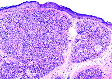 Pyogenic Granuloma Histology