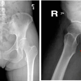 Postoperative Radiograph Of Right Hip Showing Resection Of Lesser