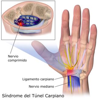 S Ndrome Do T Nel Carpiano Wikipedia A Enciclopedia Libre