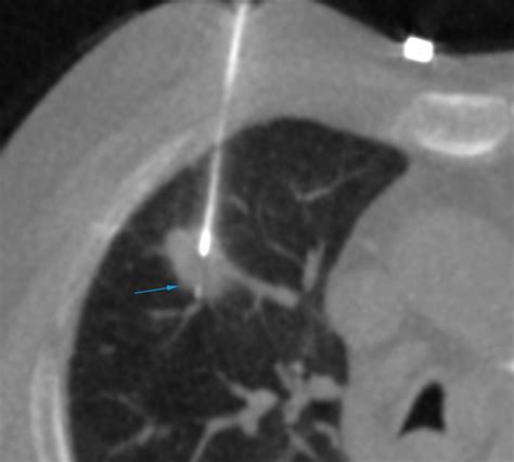 Case 120 Right Upper Lobe Lung Nodule Biopsy Patient Wants To Fly