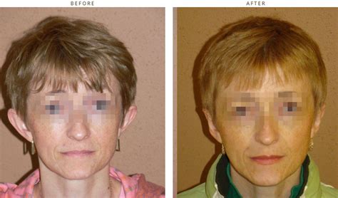 Otoplasty Ear Setback Before After Pictures Dr Turowski