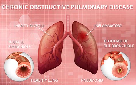 Chronic Obstructive Pulmonary Disease Educational Diagram 1338074