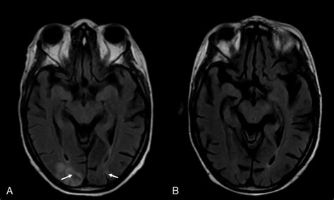 Brain MRI (T2-FLAIR) showing occipital cortical and subcortical white ...