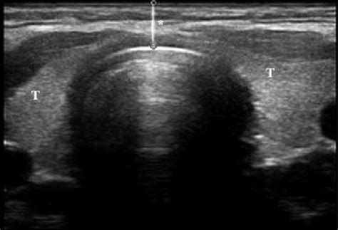 Thyroid Isthmus Ultrasound