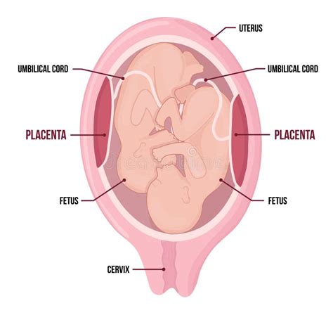 Twins In The Womb Monozygotic Twins In Uterus With Single Placenta