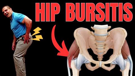 Hip Bursitis Exercise To Avoid And What To Do Instead Youtube