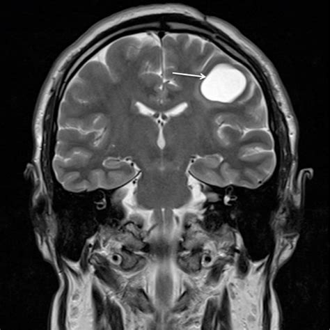 Postoperative Mri With Contrast Enhancement At Eight Months Follow Up