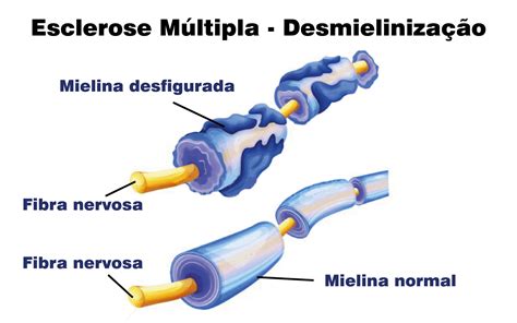 Oq E Esclerose Multipla - ESCLEROSE MÚLTIPLA | CANPP