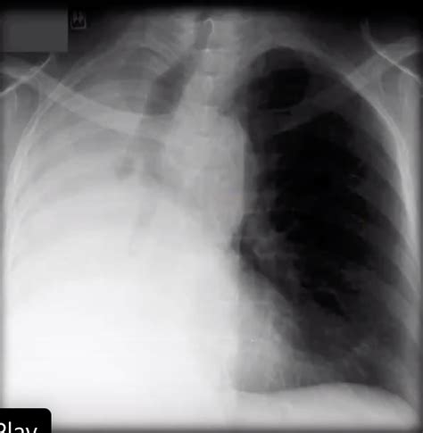 Resp Radiology Abnormal Chest X Ray Flashcards Quizlet