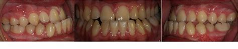 Pretreatment Extraoral Photographs A Frontal View B Frontal With