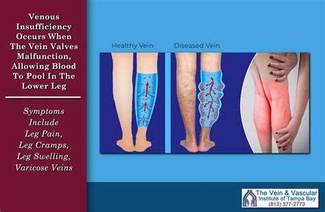 Venous Insufficiency Happens When The Valves Inside The Leg Veins Start