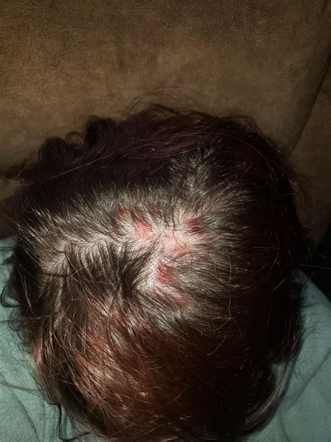 Not dx, scalp sores? : r/lupus