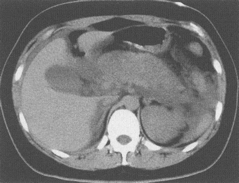 例9 急性胰腺炎 CT读片指南 医学