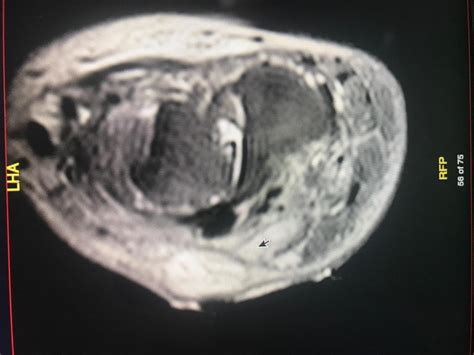 Osteomyelitis Article