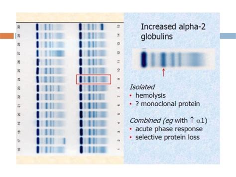 Electrophoresis Serum Protein Test Results