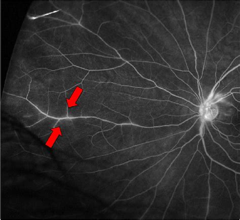 Fluorescein Angiogram Of The Left Eye Demonstrating Regions Of Retinal