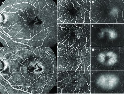 Analysis Of Fundus Fluorescein Angiographic Ffa Images All Left