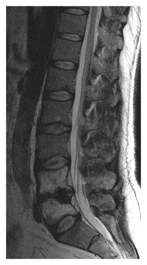 A Follow Up Magnetic Resonance Imaging MRI Examination Of The Spine