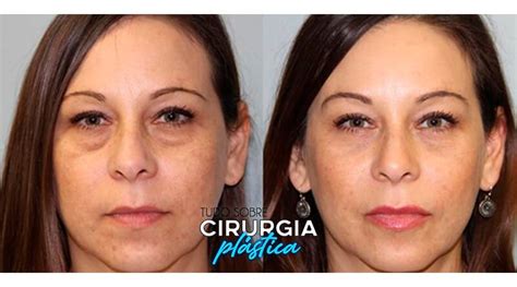 Blefaroplastia O Que Pre O Antes E Depois Fotos Em Tudo