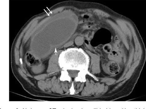 Figure 2 From A Rare Etiology Of Acute Abdomen Syndrome Gallbladder Torsion Semantic Scholar