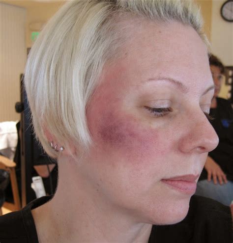 Albums 105 Pictures Pictures Of Bruises On Face Completed