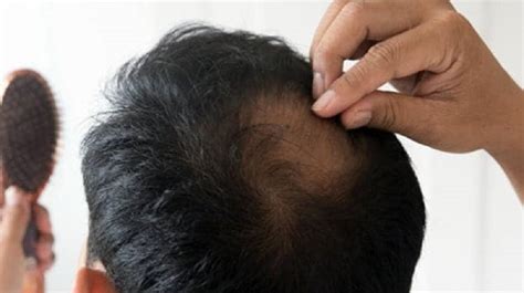 Hair Fall Remedies এই ৬ খাবার খেলে অত্যধিক চুল পড়ে টাক পড়ার আগে