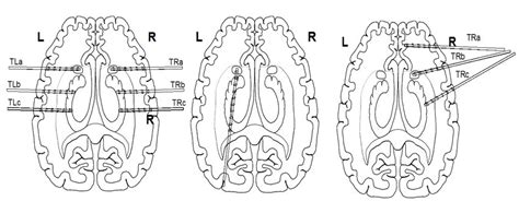 Typical Positions Of Deep Brain Electrodes Download Scientific Diagram