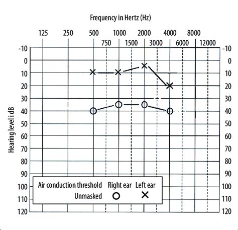 The Pure Tone Audiometry PTA Of The Right And Left Ear Y Axis Is The