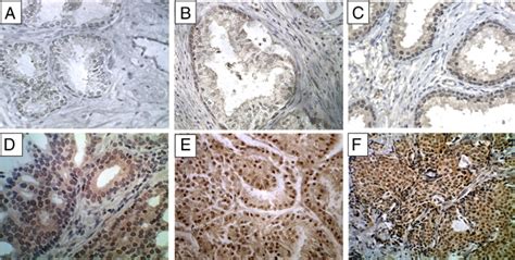 Abnormal Nuclear Expression Of Kaiso In Prostate Cancer Specimens