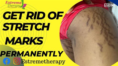 How To Get Rid Of Stretch Marks Permanently Stretch Marks Removal