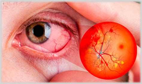 Retinopatía Diabética qué es síntomas y tratamiento Top Doctors