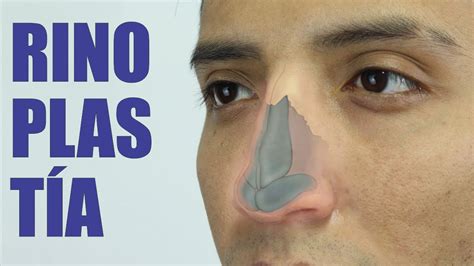 RinoseptoplastÍa Nariz Grande Y Desviada 👃🏼 RinoplastÍa Estética Y