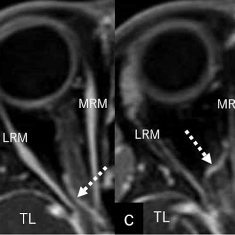 Serial Post Contrast Axial T1 Weighted Magnetic Resonance Images A C