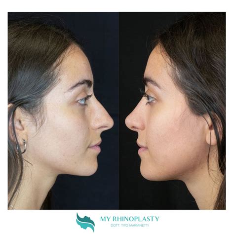 Rifarsi Il Naso Il Periodo Migliore Per La Rinoplastica My Rhinoplasty