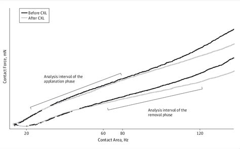 Figure 1 From Increased Corneal Hysteresis After Corneal Collagen