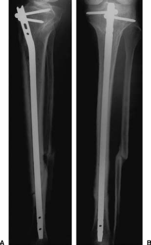 Tibial Shaft Fractures Intramedullary Nailing Musculoskeletal Key