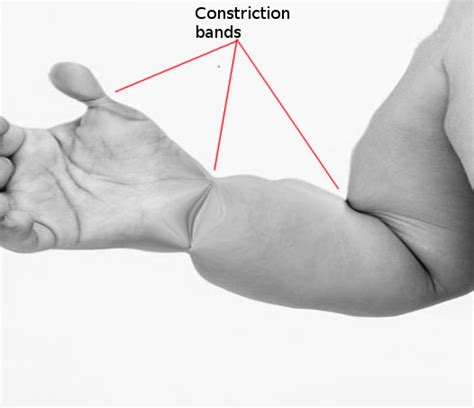 Amniotic Band Syndrome Statpearls Ncbi Bookshelf