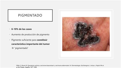 Carcinoma Basocelular Espinocelular Y Su Tratamiento Ppt