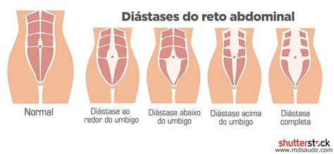 O que é diástase do reto abdominal MD Saúde