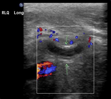 Appendicitis Ultrasound Criteria