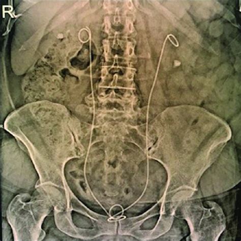 The Left Ureteral Stone Was Removed And Bilateral D J Stents Were