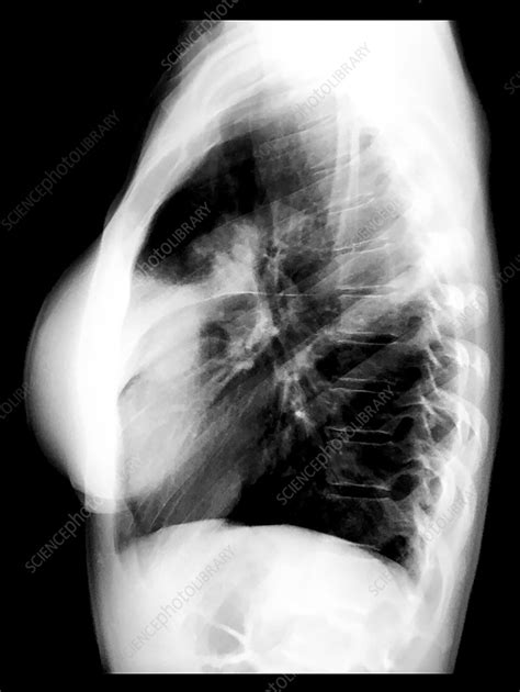 Lung Cancer X Ray Stock Image C058 4477 Science Photo Library