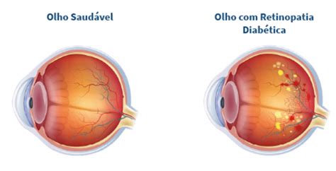 O Que Retinopatia Diab Tica Proliferativa Ioa Instituto De Olhos