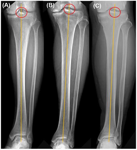 Accuracy of the Tibial Component Alignment by Extramedullary System