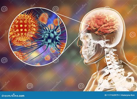 Viral Meningitis And Encephalitis Medical Concept Stock Illustration