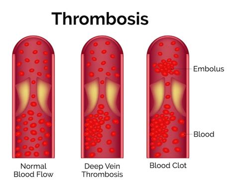 Premium Vector Thrombosis Normal Blood Flow Deep Vein Thrombosis